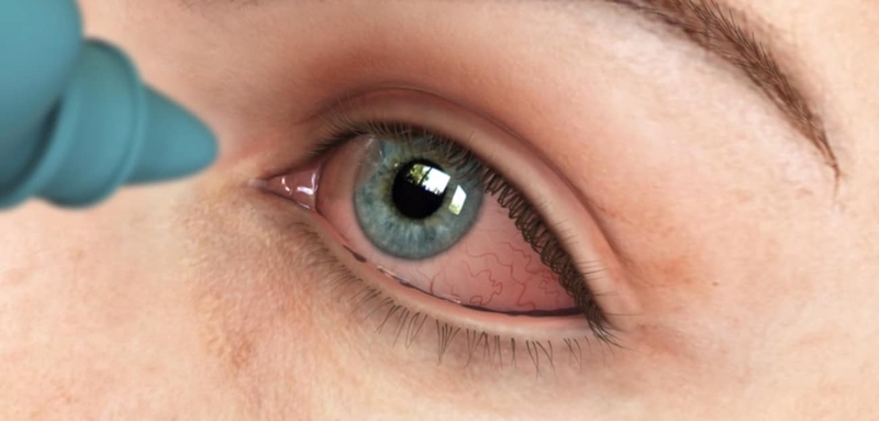 Đeo lens nhiều có hại mắt không?2