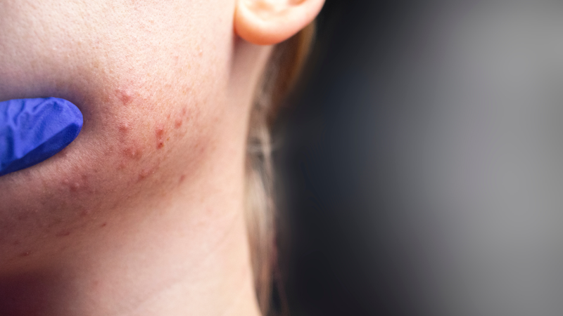 Derma Angel - Bí quyết cải thiện làn da mụn 1