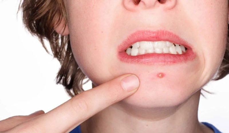 Derma Angel - Bí quyết cải thiện làn da mụn 2