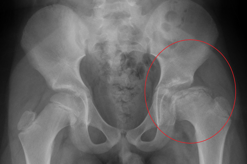 Dẹt chỏm xương đùi là bệnh như thế nào?1