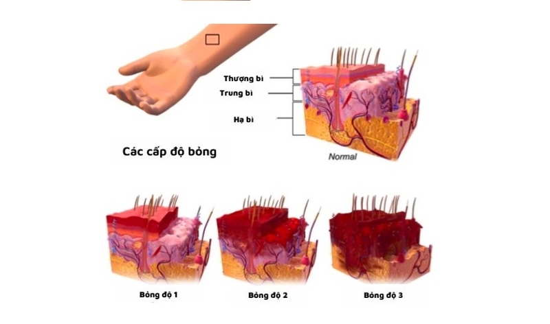 Di chứng của bỏng 2