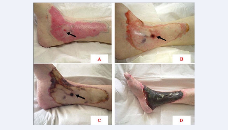 Di chứng của bỏng 4