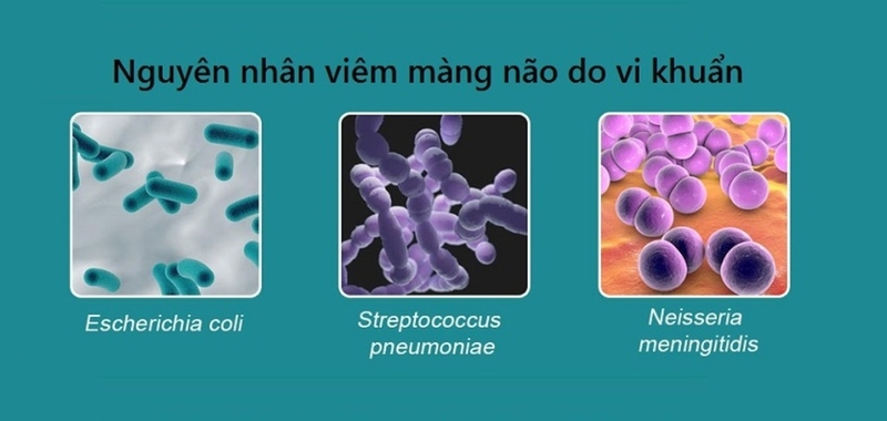 di chứng viêm màng não mủ 3