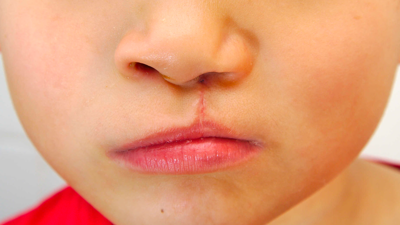 Dị dạng bán cầu não là gì? Nguyên nhân, triệu chứng và cách điều trị 4