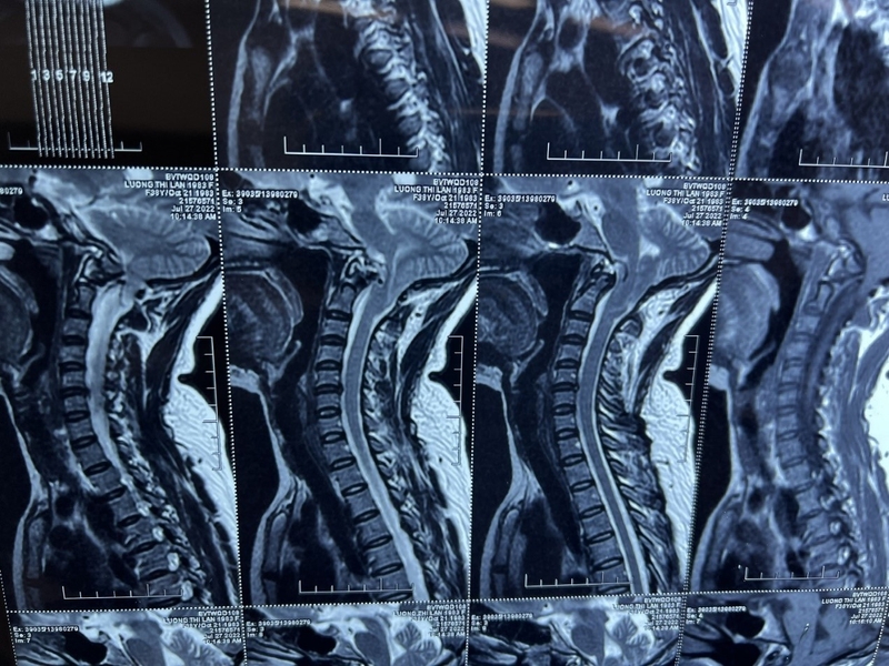 di-dang-chiari-co-may-loai-va-co-trieu-chung-nhu-the-nao 2.jpg