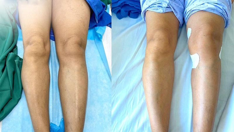 Dị dạng động mạch thận là gì? Các biến chứng có thể gặp phải 5