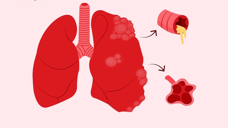 Dị dạng động mạch thận là gì? Các biến chứng có thể gặp phải 4