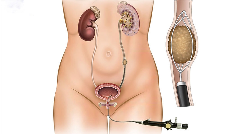 Dị dạng động mạch thận là gì? Các biến chứng có thể gặp phải 3
