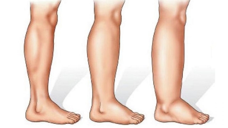 Dị dạng mạch máu là gì? Có bao nhiêu loại dị dạng mạch máu?3