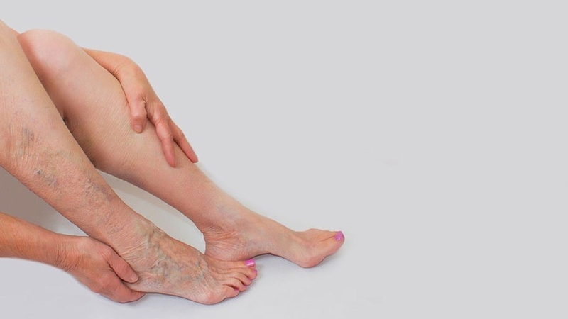 Dị dạng tĩnh mạch là gì? Cách chẩn đoán và điều trị dị dạng tĩnh mạch 1