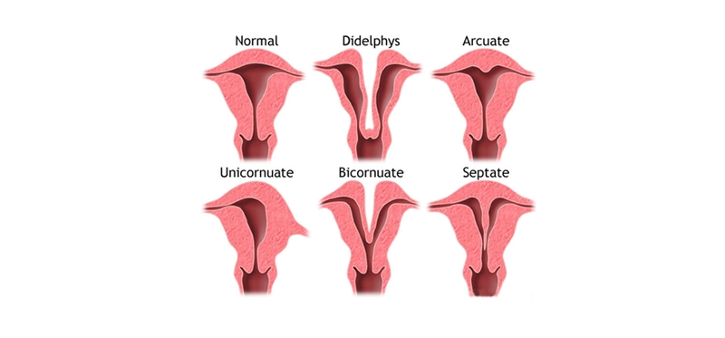 Dị dạng tử cung bẩm sinh có nhiều kiểu khác nhau