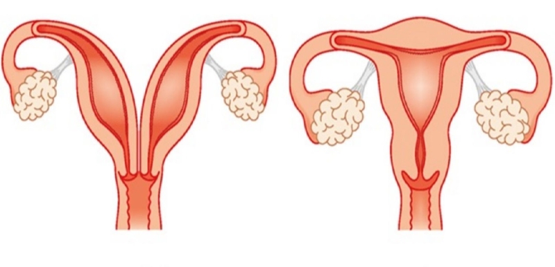 Tử cung đôi là dị tật tử cung thường gặp và vẫn có khả năng mang thai