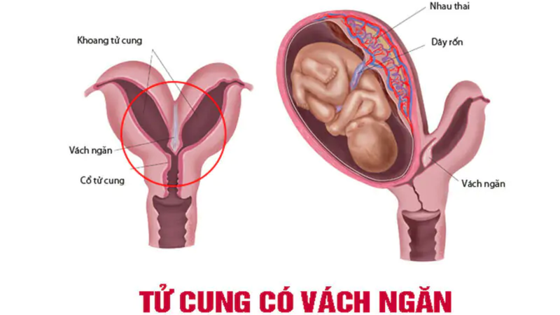 Dị dạng tử cung: Liệu có thể mang thai? 3