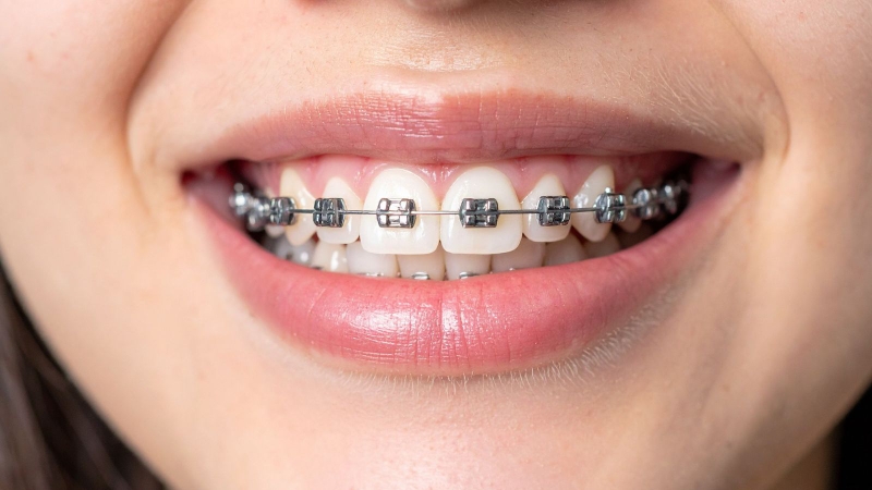 Đi du học có niềng răng được không?