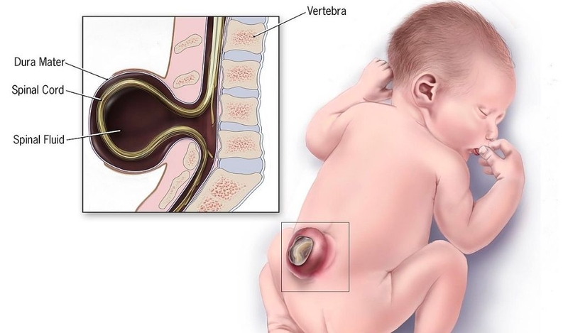 Dị tật cột sống chẻ đôi là gì? Chẩn đoán và điều trị như thế nào? 1