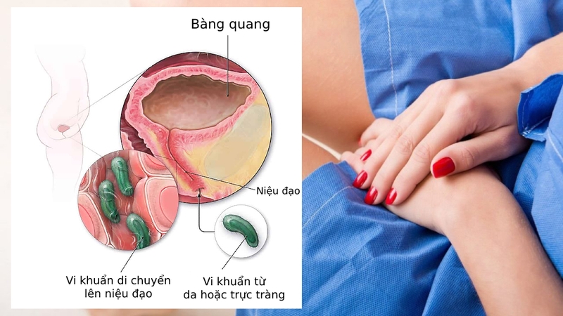 Đi tiểu buốt uống lá cây gì? Các bài thuốc trị tiểu buốt 1
