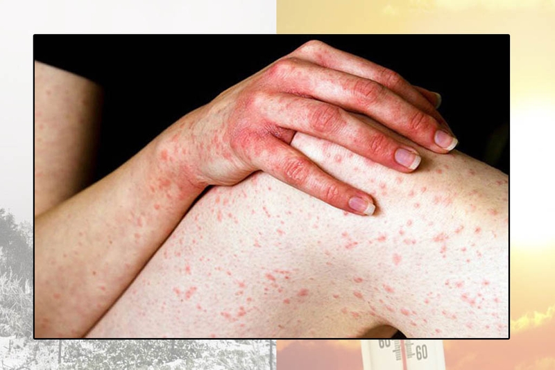 Dị ứng thời tiết có nguy hiểm không? Làm cách nào để phòng tránh