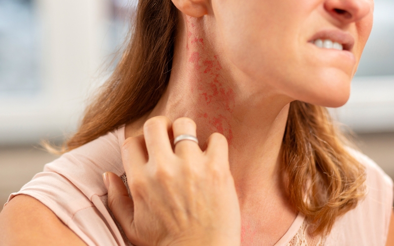 Dị ứng thuốc kháng sinh bao lâu thì khỏi? 3