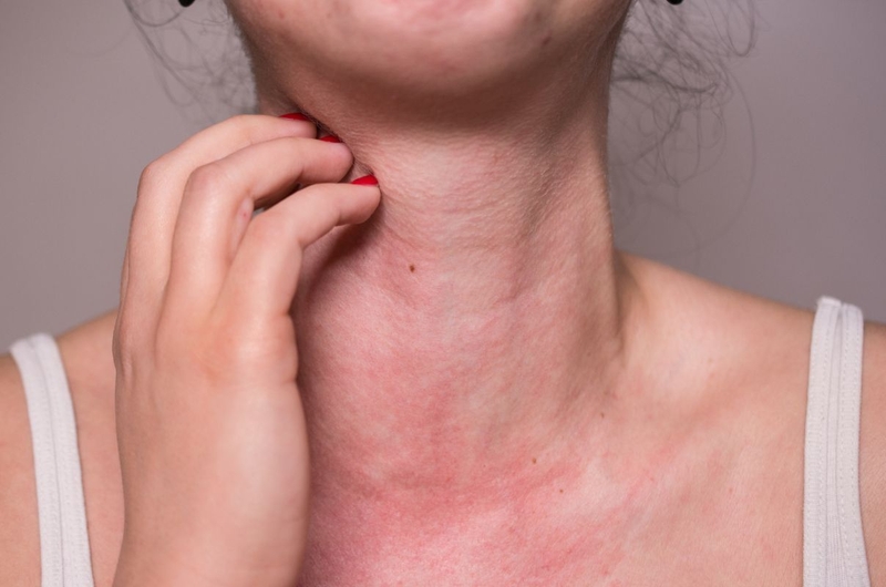 Tình trạng dị ứng cá và những thông tin quan trọng cần biết 2