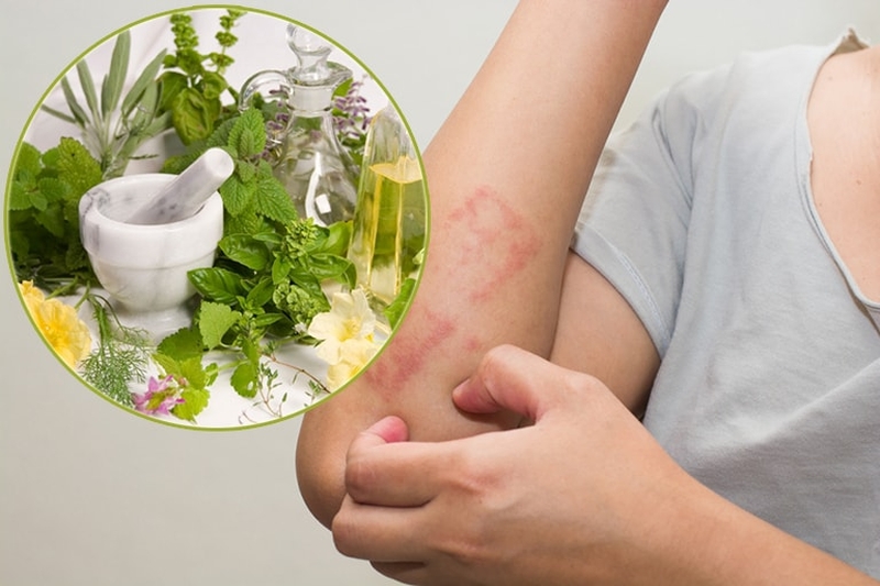 Dị ứng các loại thuốc: Dị ứng thuốc nam1
