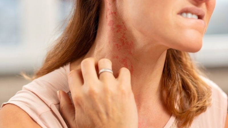 Dị ứng chuối và những điều mà bạn nên biết 2