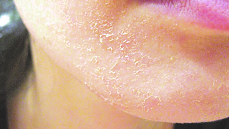 Dị ứng cồn trong mỹ phẩm: Dấu hiệu nhận biết và cách xử lý 2