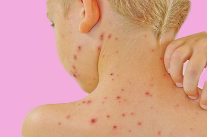 Khi bị dị ứng hóa chất không nên tự điều trị mà nên thăm khám bác sĩ da liễu để soi da