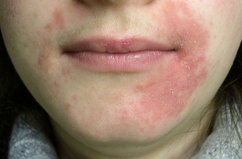 Dị ứng da mặt sưng phù là do đâu? 2
