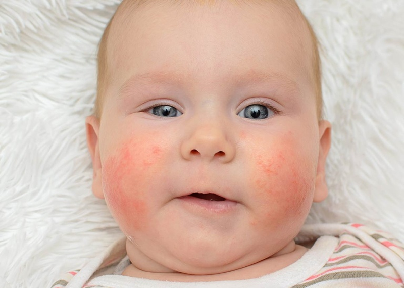 Dị ứng da mặt sưng phù là do đâu? 3