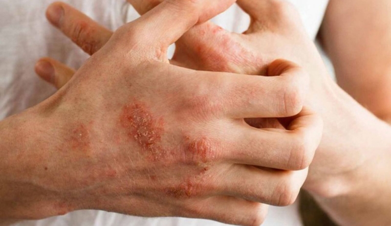 Dị ứng da ngứa toàn thân: Nguyên nhân và cách khắc phục3