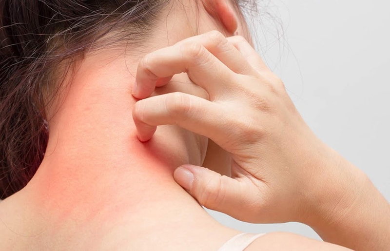 Dị ứng da sau khi tắm có nguyên nhân do đâu? 2