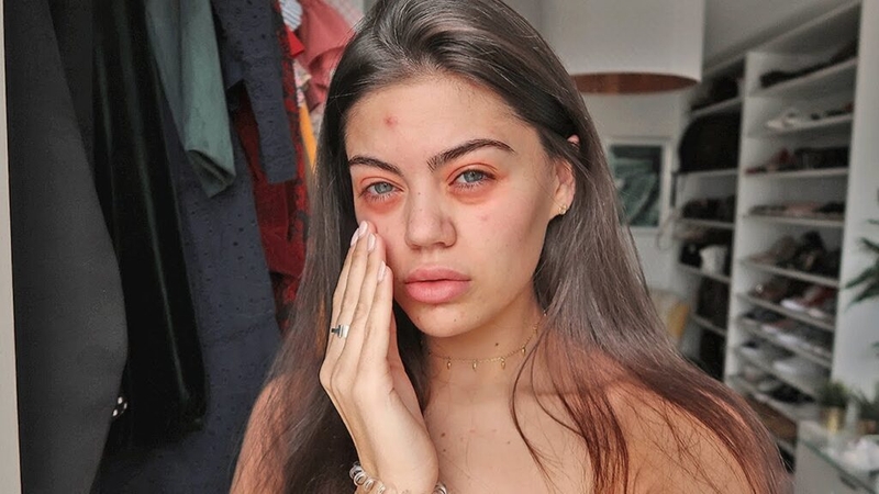 Dị ứng da sưng môi - Chứng bệnh nguy hiểm không thể bỏ qua! 1