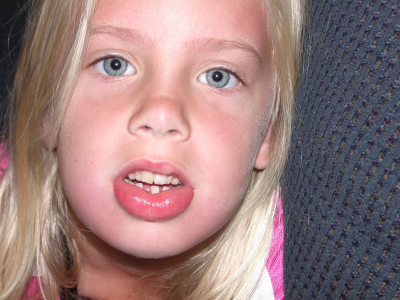 Dị ứng da sưng môi - Chứng bệnh nguy hiểm không thể bỏ qua! 3