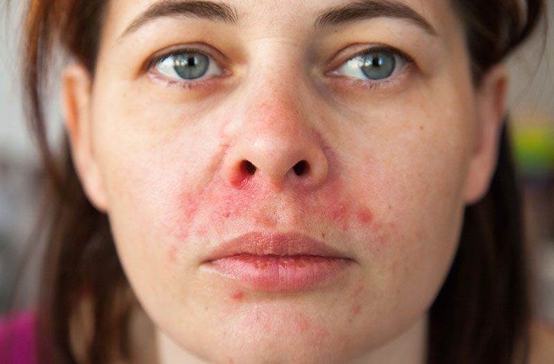 Dị ứng da quanh vùng miệng có thể xuất hiện ở mọi lứa tuổi