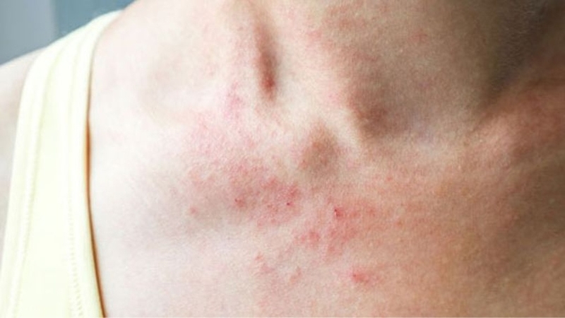 Dị ứng đậu phộng: Dấu hiệu và cách xử lý nhanh chóng 3