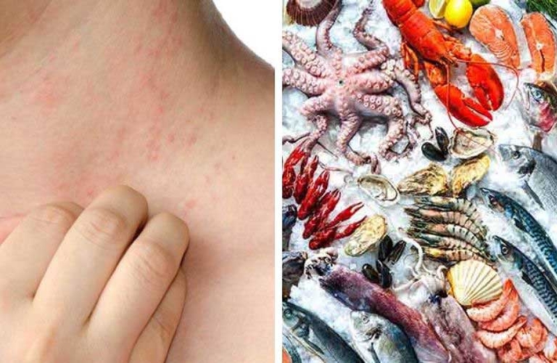 Dị ứng hải sản có tiêm vacxin Covid - 19 được không? 1