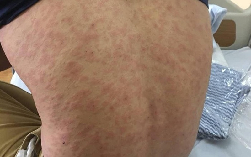 Dị ứng hải sản có tiêm vacxin Covid - 19 được không? 2