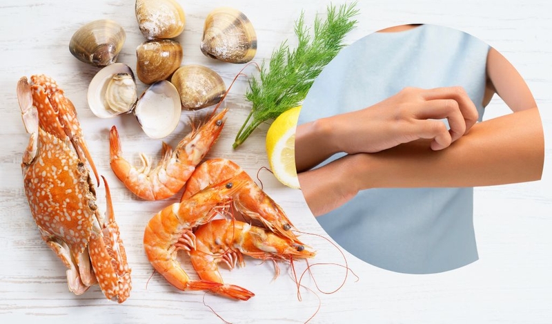 Dị ứng hải sản kéo dài bao lâu và ăn hải sản đúng cách như thế nào? 1