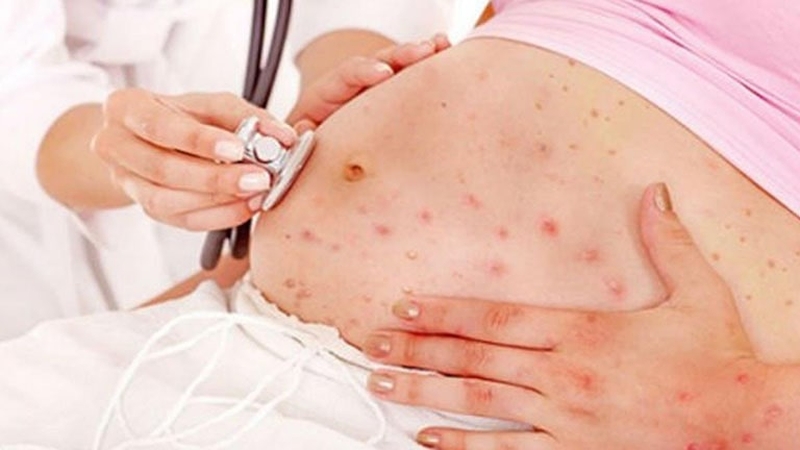 Dị ứng hải sản bị sưng môi và các cách phòng tránh 3