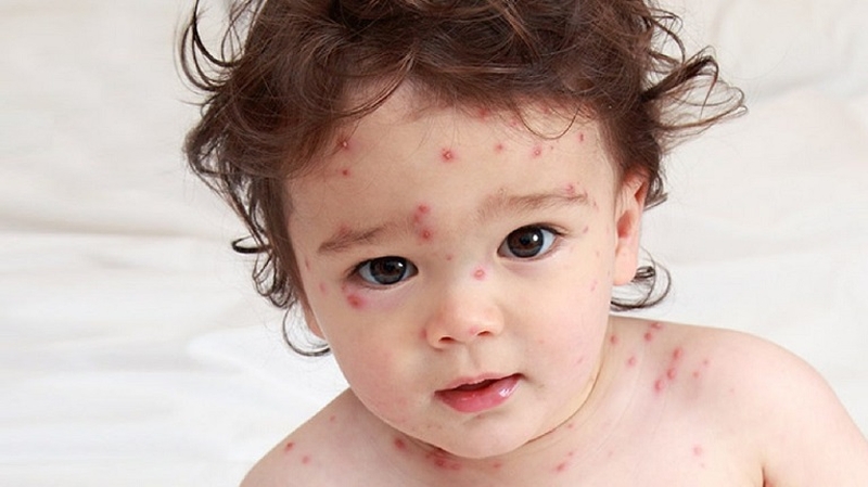 Giải đáp thắc mắc: Trẻ em bị dị ứng với hải sản phải làm sao? 2