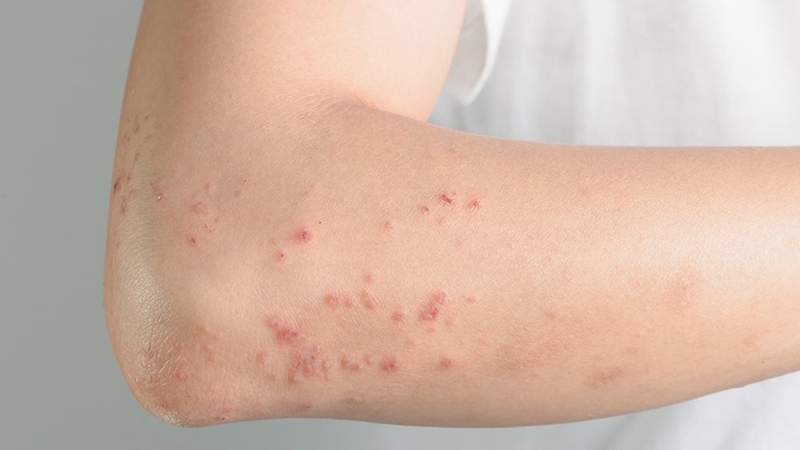 Dị ứng hạt điều: Nguyên nhân, triệu chứng và cách xử lý 2