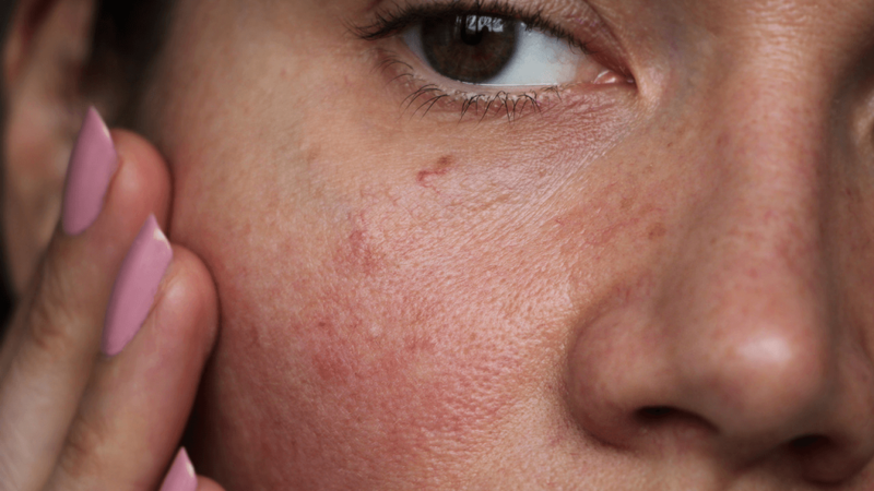 Dị ứng kem chống nắng: Nguyên nhân và cách khắc phục hiệu quả 1