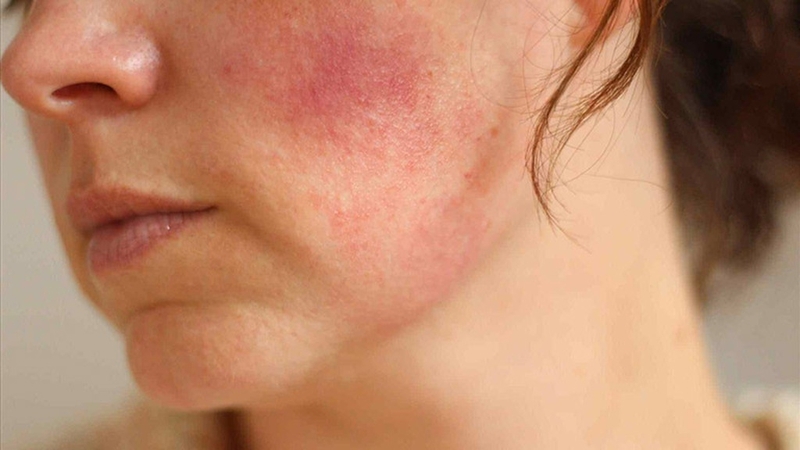 Dị ứng kem chống nắng: Nguyên nhân và cách khắc phục hiệu quả 2