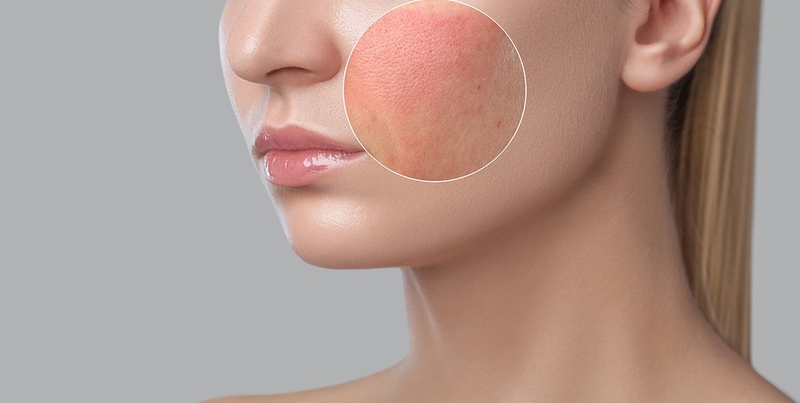 Dị ứng kem dưỡng da khiến da xuất hiện mẩn đỏ, bị khô căng và cảm giác thiếu nước trầm trọng