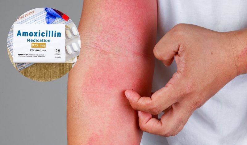Dị ứng kháng sinh amoxicillin là gì? Tác dụng phụ khác khi dùng thuốc 2