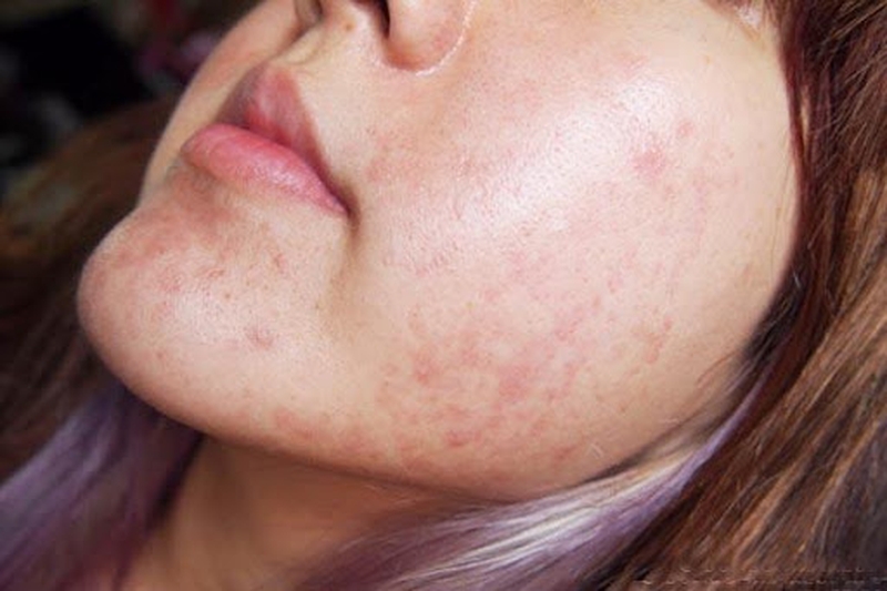 di-ung-khang-sinh-penicillin 2