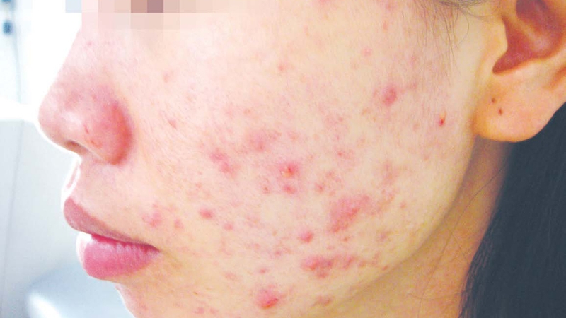 Cách trị mụn do dị ứng mỹ phẩm 2