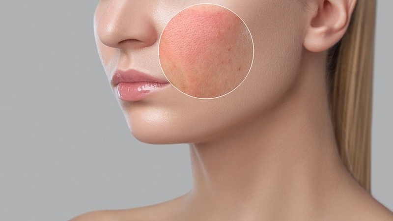 Dị ứng mỹ phẩm nên bôi thuốc gì? 1