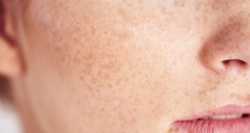 Dị ứng mỹ phẩm nổi mụn nước cần được xử lý như thế nào cho an toàn? 2