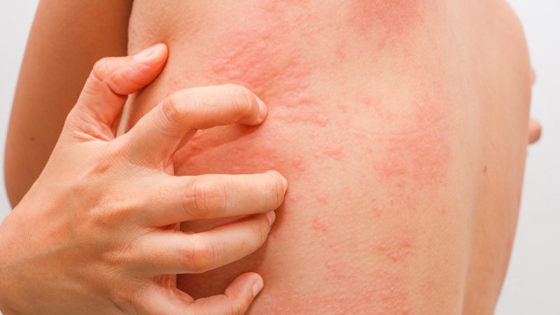 Dị ứng nắng: Nguyên nhân, tác hại và cách phòng ngừa 1